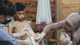 Ibnu Umair Ibrahim, anak penderita Tumor Abdomen di Kelurahan Donggala Kodi/Ist
